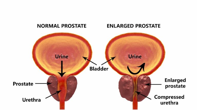 30+ Prostate Cancer Symptoms Blood In Urine Pictures ...