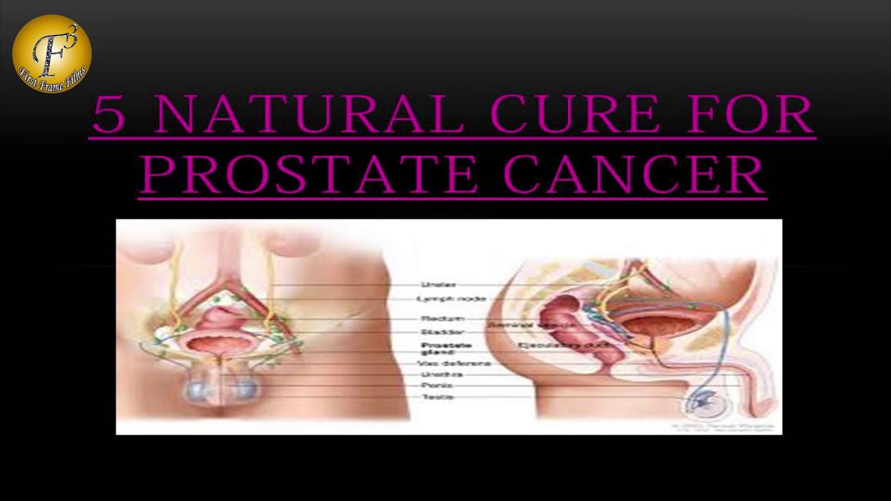 5 NATURAL CURE FOR PROSTATE CANCER II à¤ªà¥?à¤°à¥à¤¸à¥?à¤à¥à¤ à¤à¥à¤à¤¸à¤° à¤à¥ 5 ...