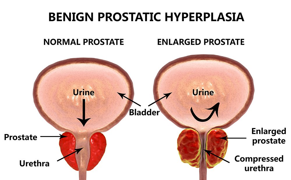 6 Signs You May Have an Enlarged Prostate