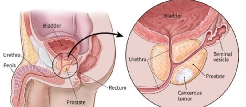7 Tips That Can Help You Prevent Prostate Cancer