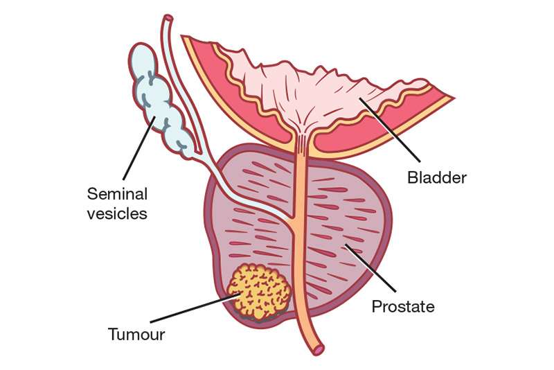 A Guide to Prostate Cancer