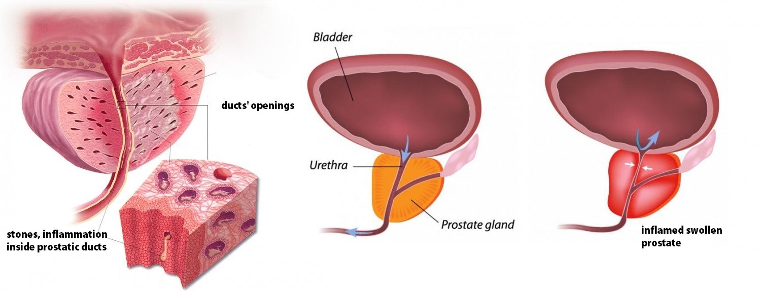 About prostatitis