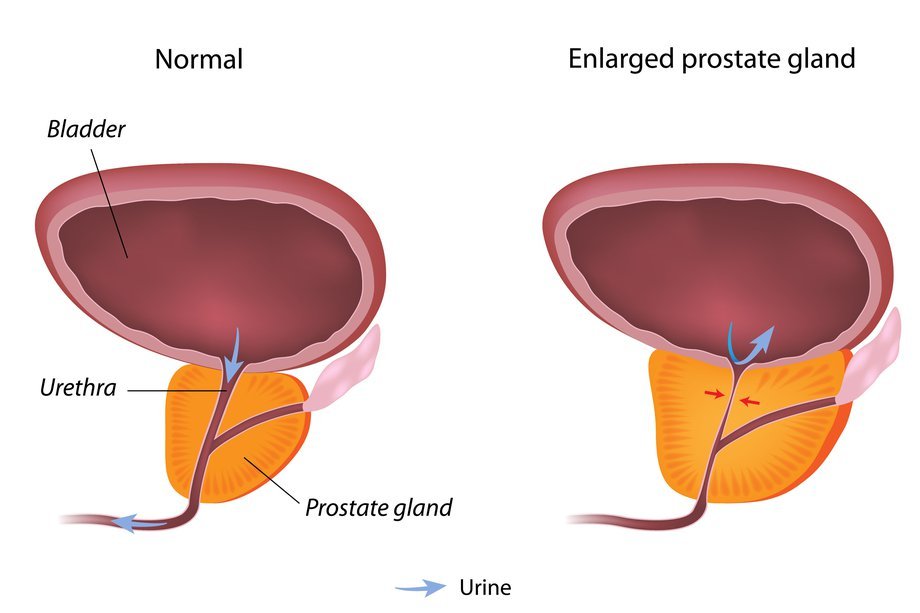 Benign prostate enlargement