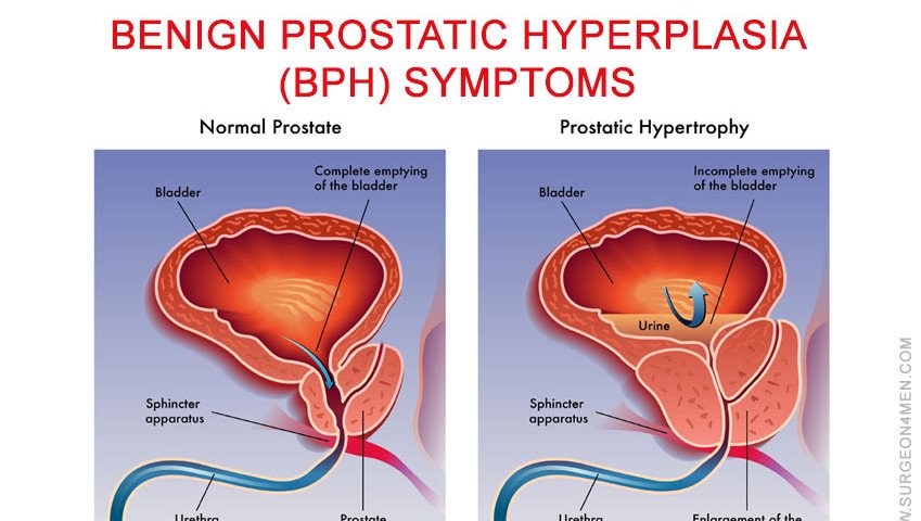 Benign Prostatic Hyperplasia (BPH) SymptomsMEC