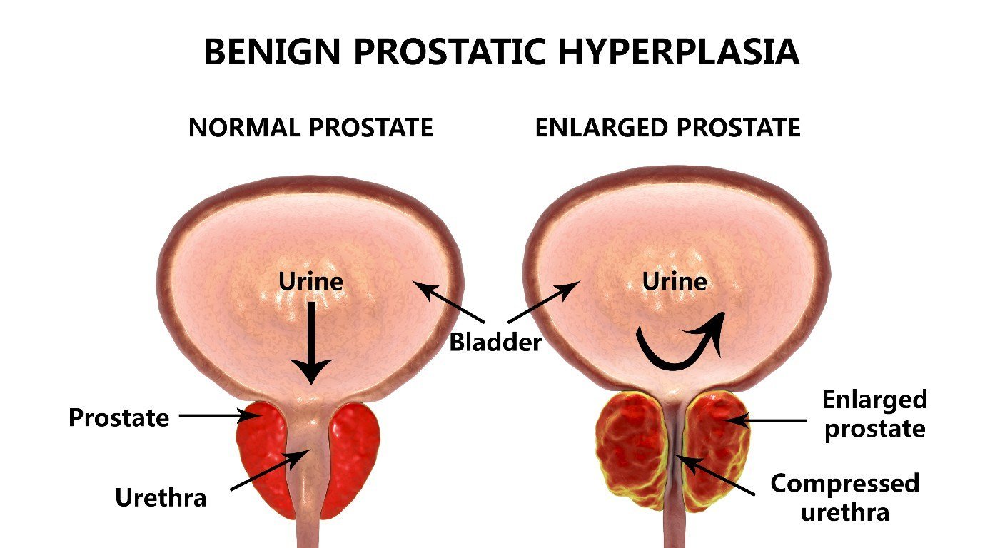 Benign Prostatic Hyperplasia Melbourne
