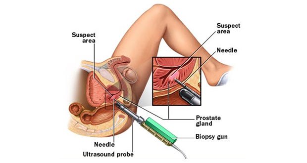 Biopsy Procedure by Dr. K. Ramesh  Chennai Urology