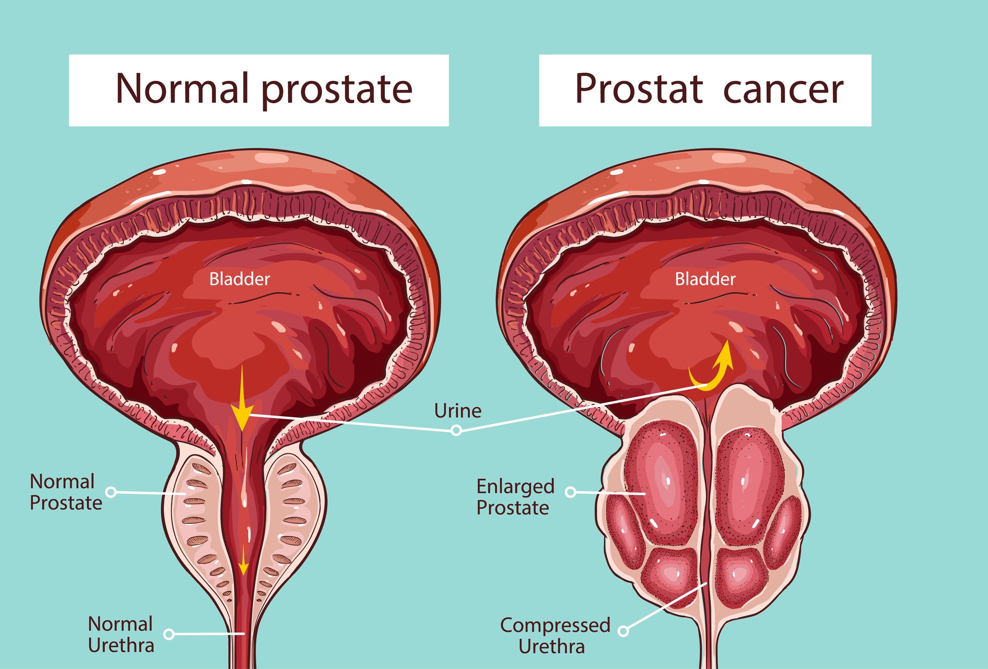 BPH (Enlarged Prostate) and Diet