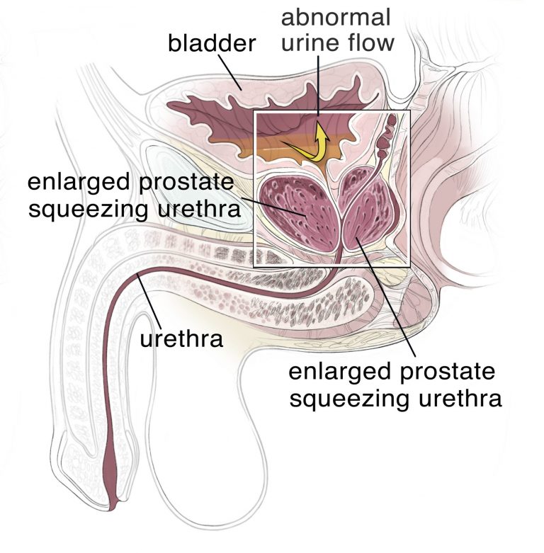 BPH/Enlarged Prostate