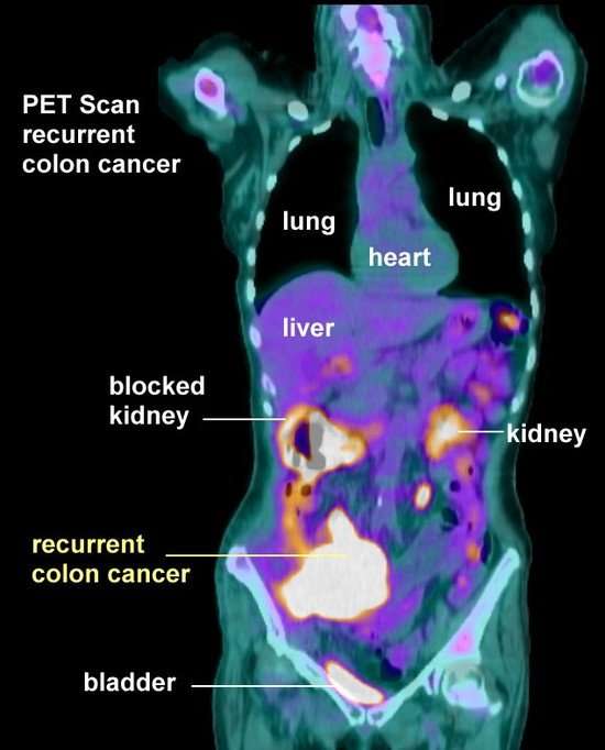 Can a CT scan or PET scan cause cancer?