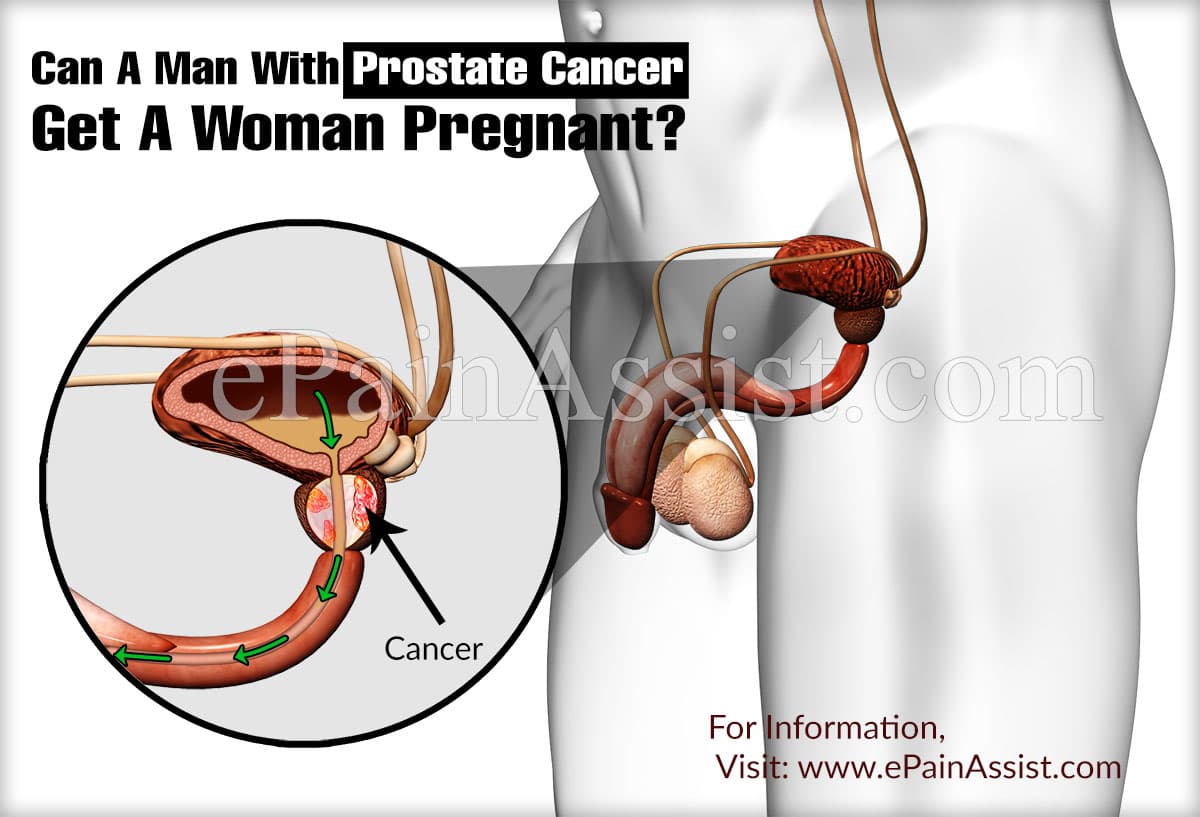 Can A Man With Prostate Cancer Get A Woman Pregnant?