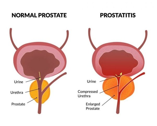 Can chronic prostatitis go away naturally?