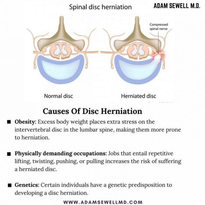 Can Herniated Disc Cause Prostate Problems