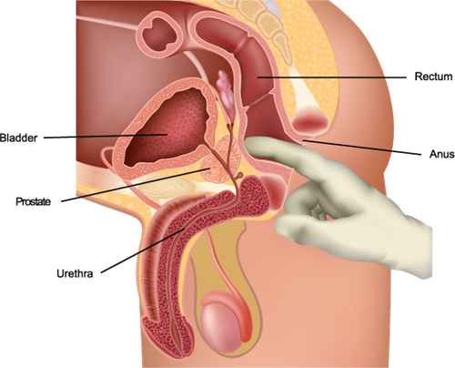 Can The Prostate Be Checked During A Colonoscopy