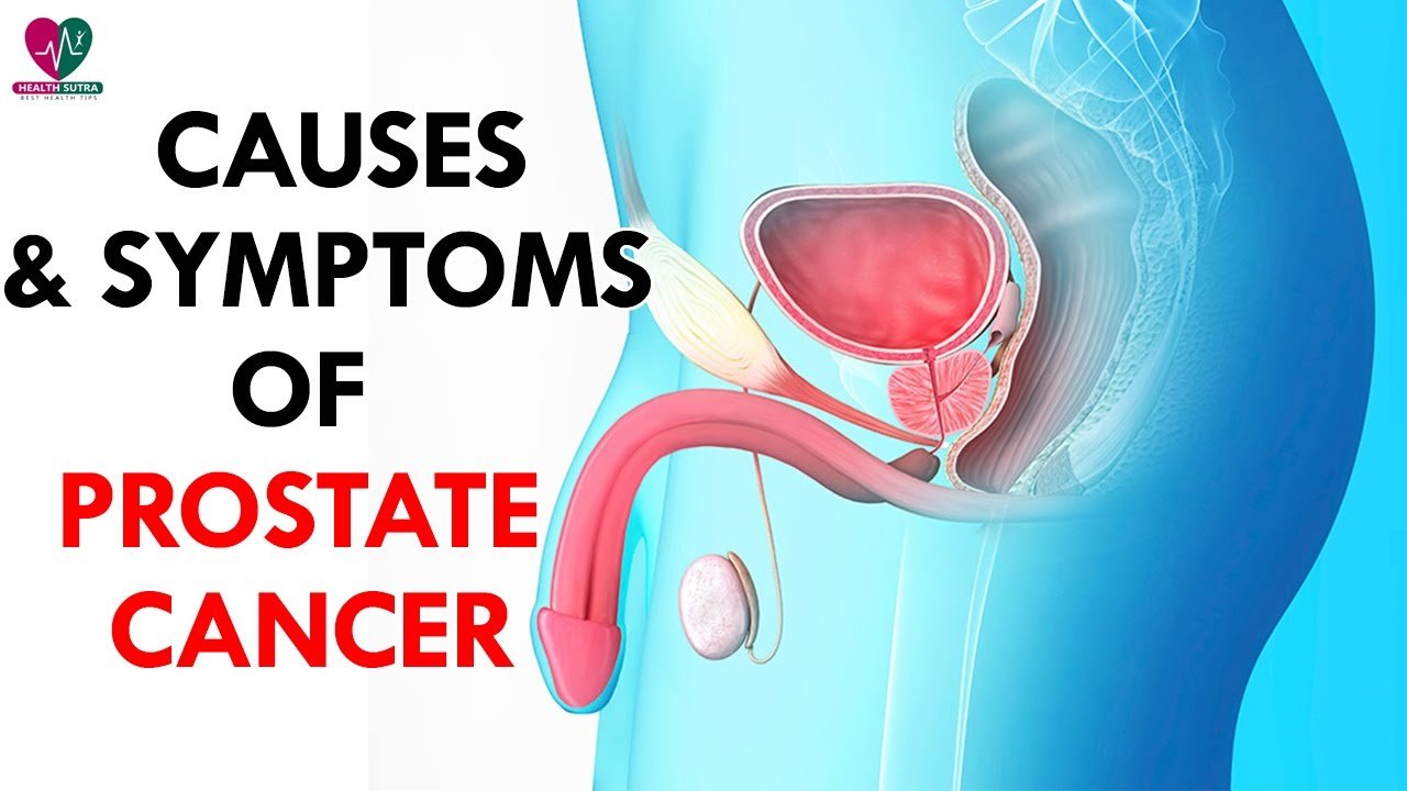Causes and Symptoms of Prostate Cancer