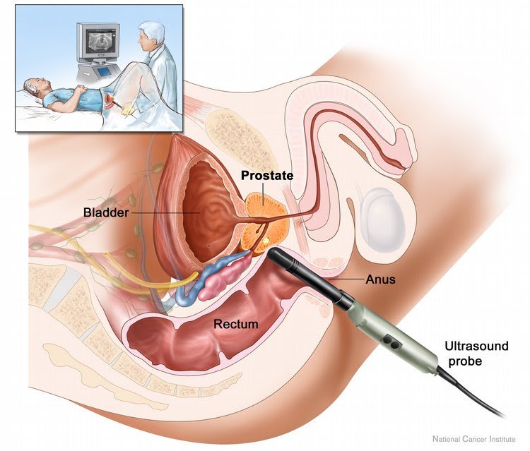 Colonoscopy After Radiation remedy For Prostate most cancers