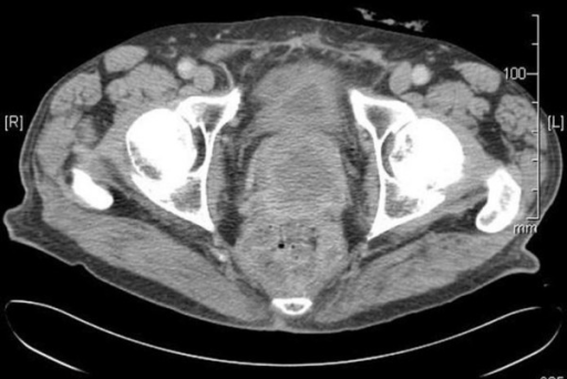 CT Scan of the Pelvis showing prostatic mass.