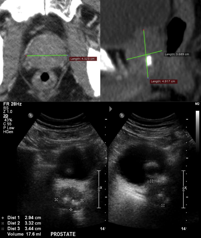 CT v TAUS. Comparison imaging of prostate volume ...