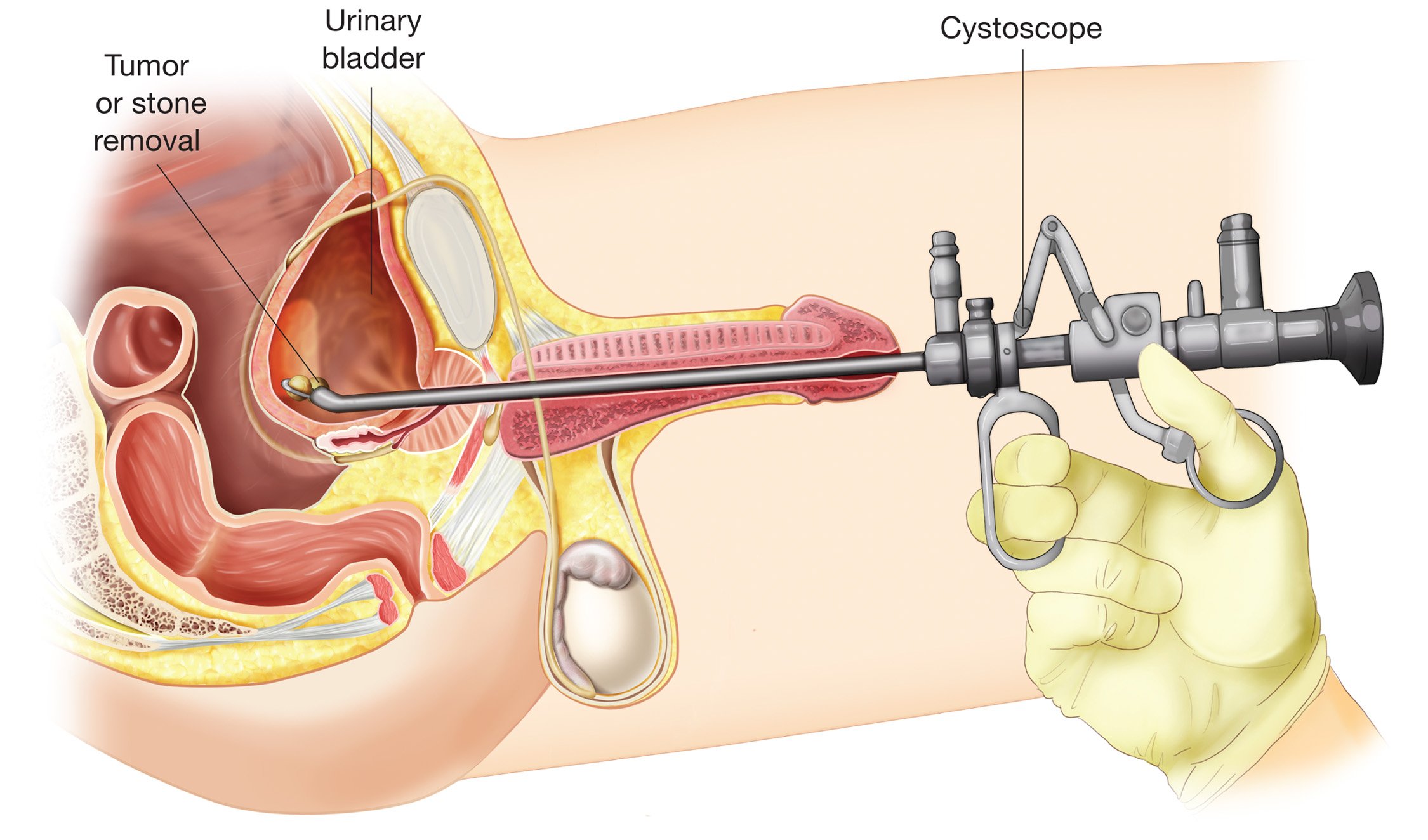 Cystoscopy Procedure, Pain, Complications, Cost