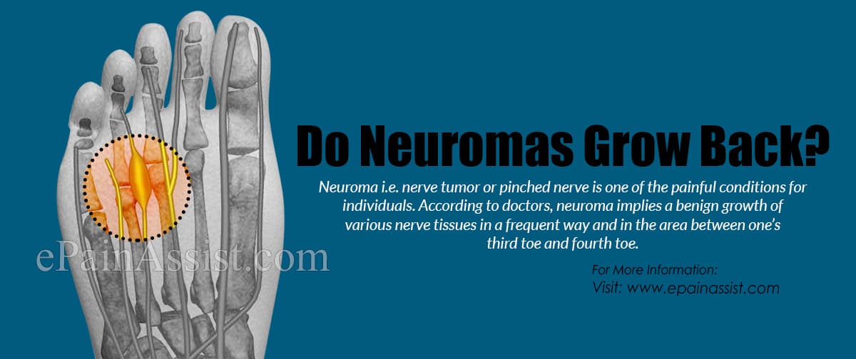 Do Neuromas Grow Back?