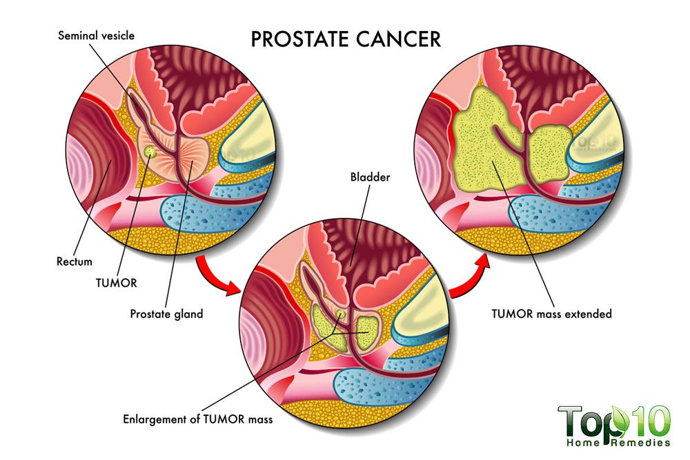 Does masturbation cause prostate cancer