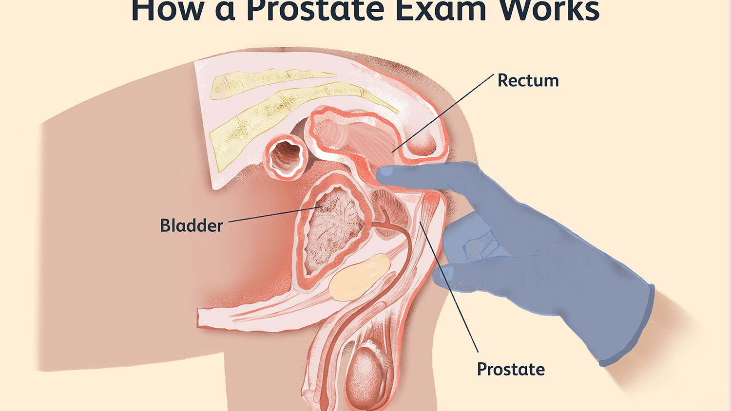 Does Prostate Cancer Always Come Back / Is Back And Hip ...