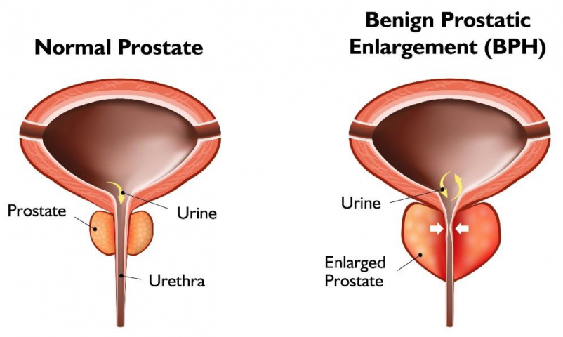 Enlarged Prostate BPH Ayurvedic Herbal Treatment in ...
