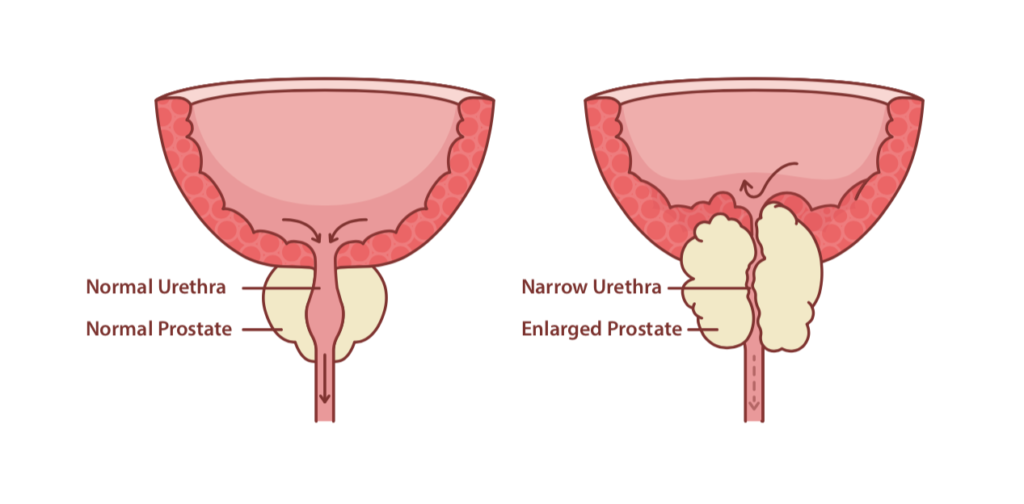 Enlarged Prostate (BPH): Causes, Symptoms, Treatments ...