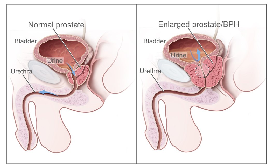 Enlarged prostate. Causes, symptoms, treatment Enlarged ...
