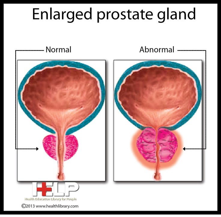 Enlarged Prostate Gland