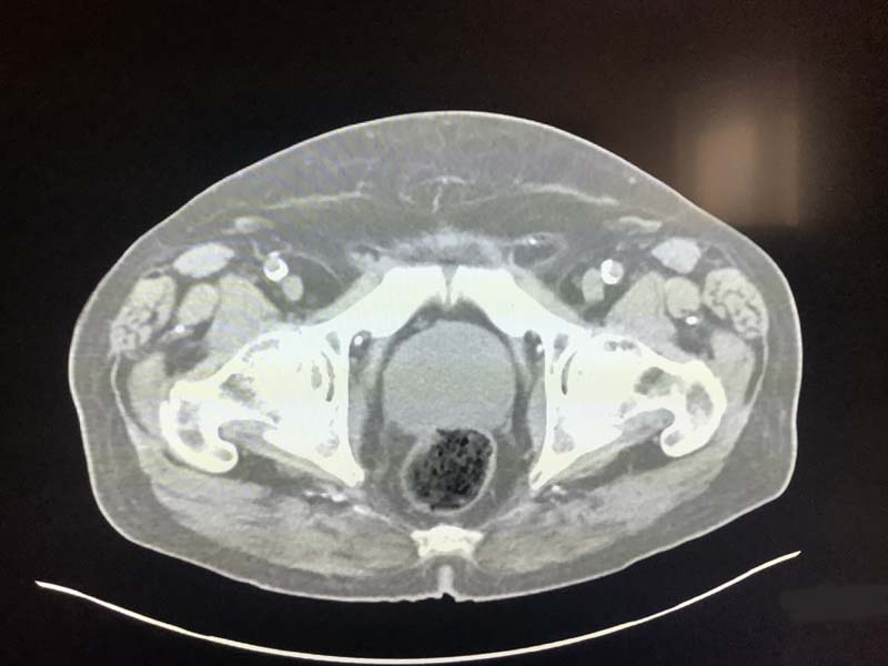 Enlarged Prostate On CT  Radiology In Plain English