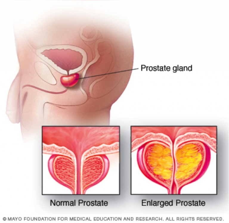 Enlarged Prostate  Sexual Health