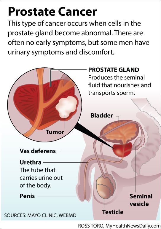 Facts About Prostate Cancer (Infographic)