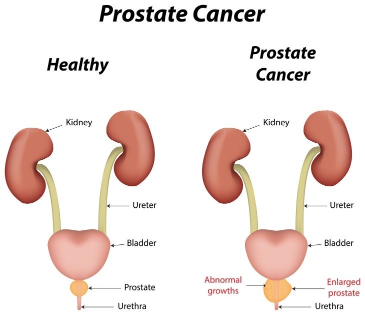 Fat Increases Prostate Cancer Development and Mortality Risk?