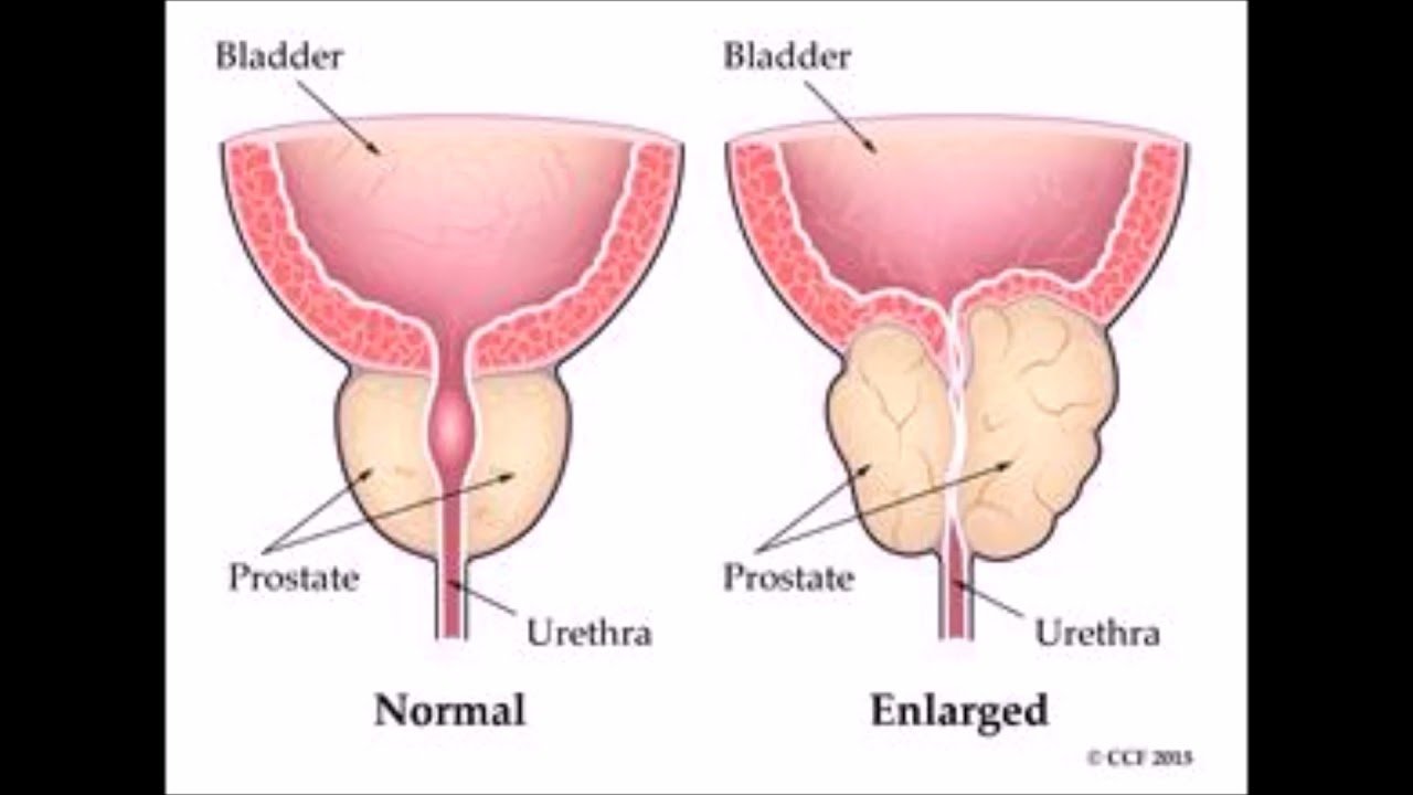 Harmful affects of Masturbation and how Prostate Cancer ...