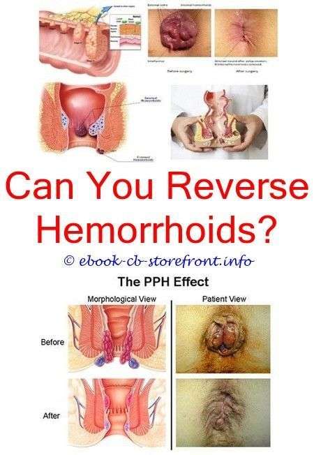Hemorrhoids may show up unexpectedly, and they are surely ...