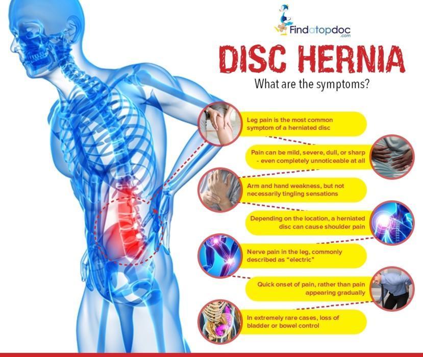 Herniated Disc: Symptoms, Causes, Treatment, and Diagnosis ...