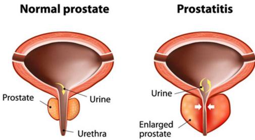 How Do You Treat Prostatitis?