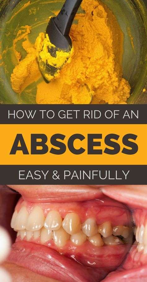 How to Get Rid of an Abscess Painless and Naturally ...