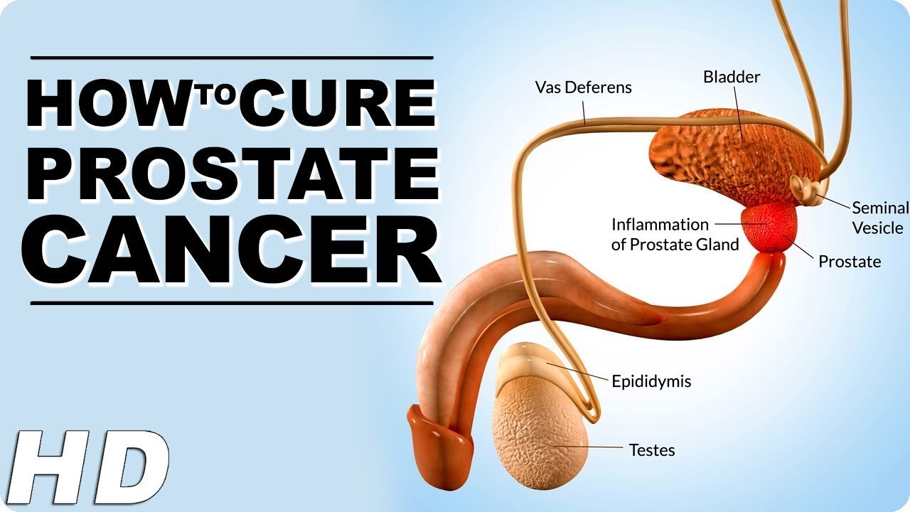How To Slow/Cure Down Prostate Cancer Naturally At Home ...