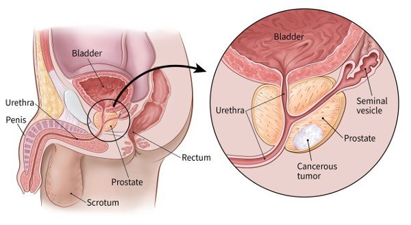 If You Have Prostate Cancer