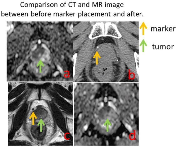 Influence of fiducial marker for MR image of prostate ...