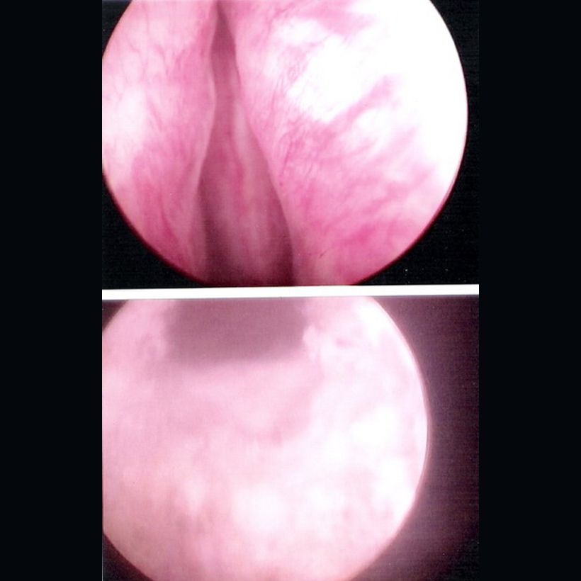Laser Vaporization of the Prostate