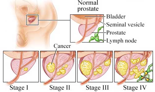 LeveragePro: Prostate Cancer Overview
