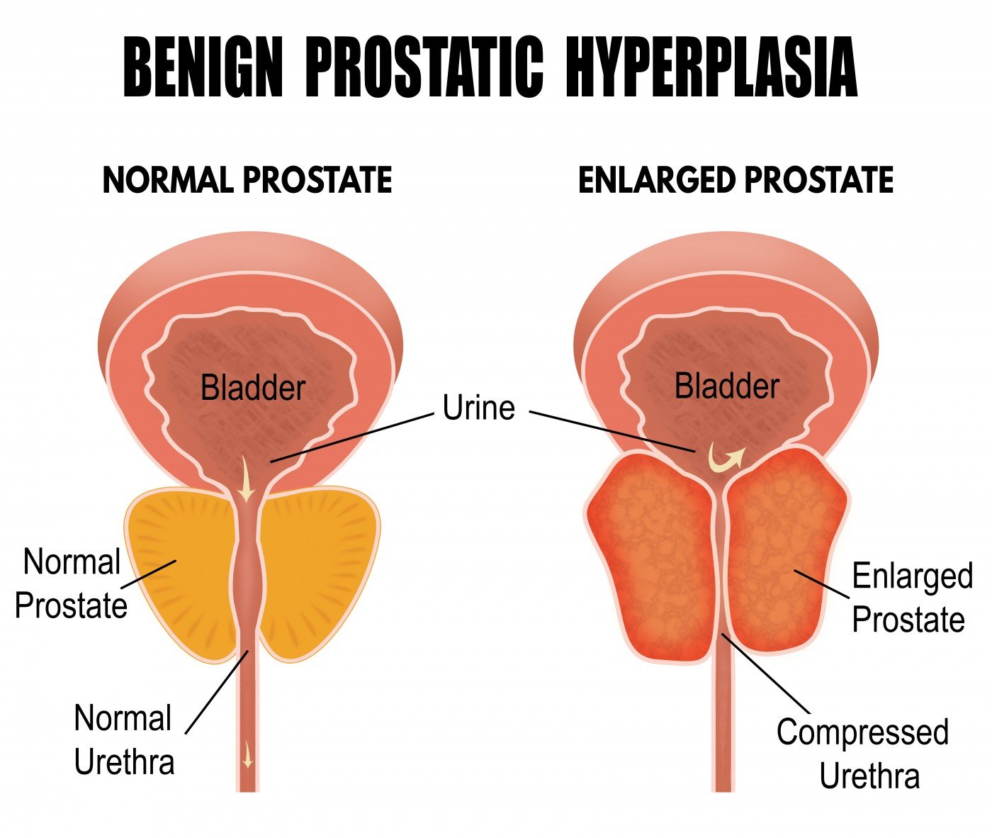 Likely Steps in Benign Prostatic Hyperplasia