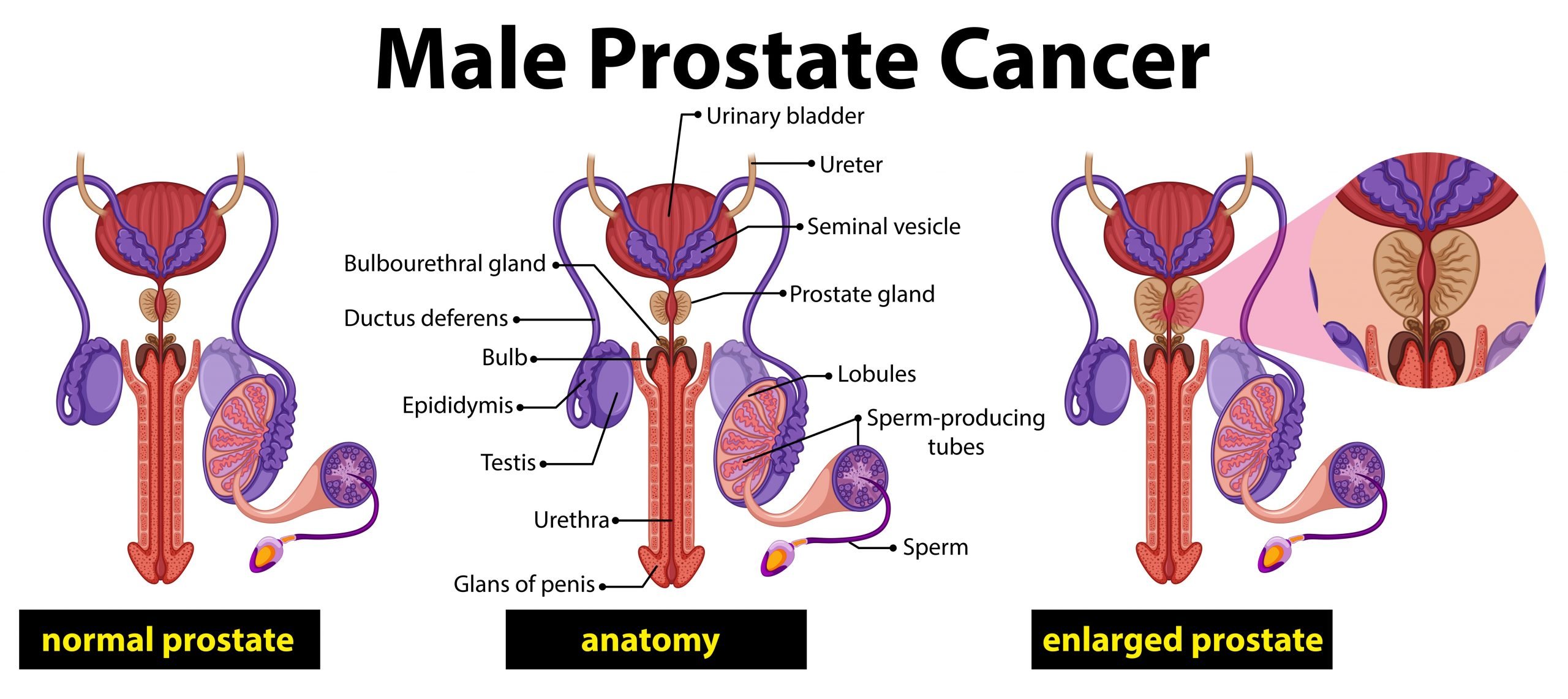 Male prostate cancer diagram 432062