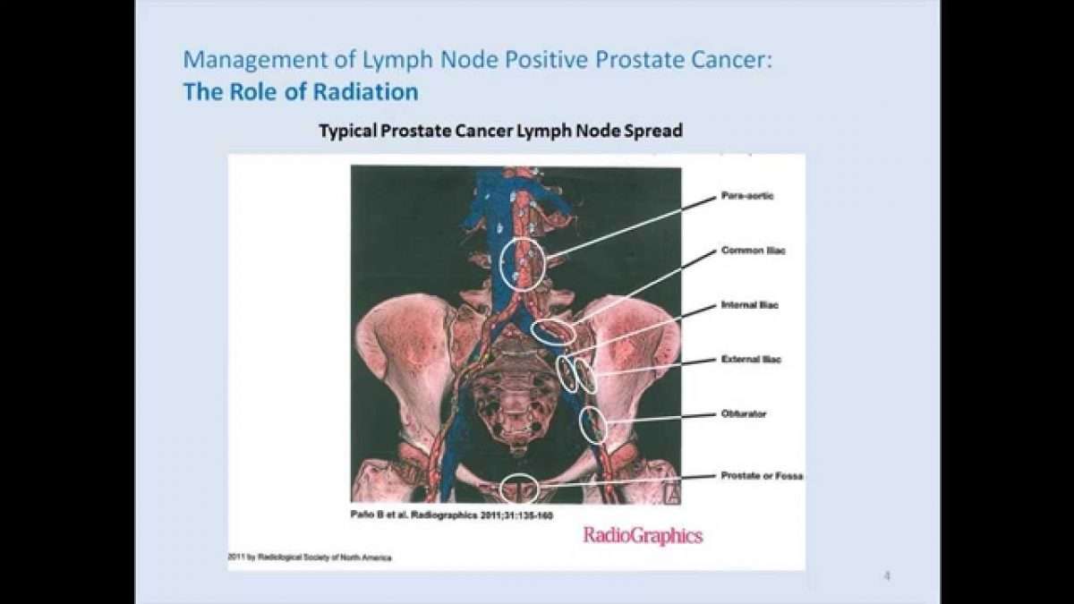 Management of Lymph Node Positive Prostate Cancer: the Role of ...