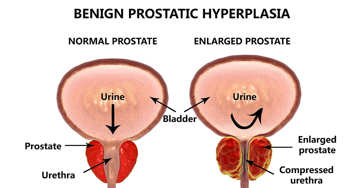 Managing Benign Prostate Hyperplasia & Peyronies Disease ...