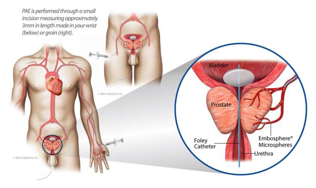 Men Have A New, Minimally Invasive Treatment Option for Enlarged ...