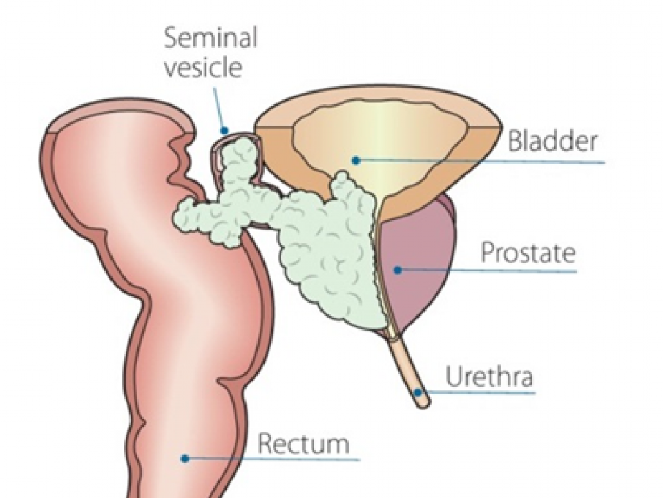 Metastatic prostate cancer