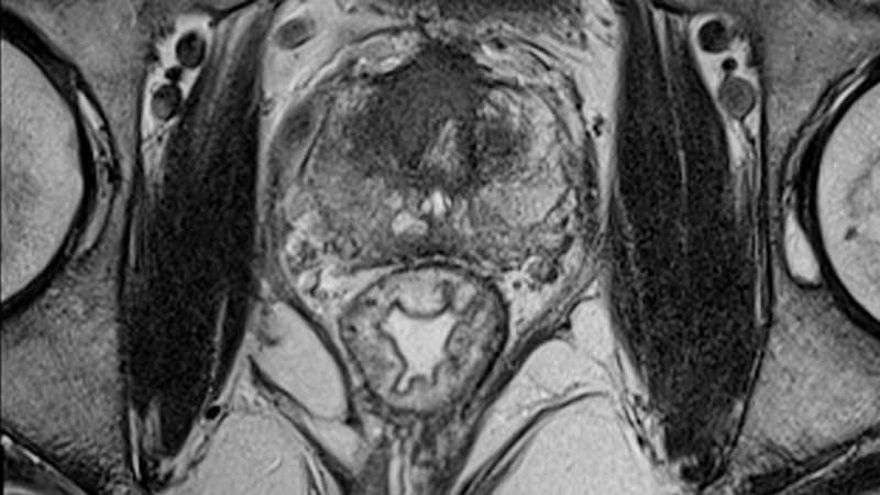 MRI Reliably Identifies Significant Prostate Cancer MRI ...